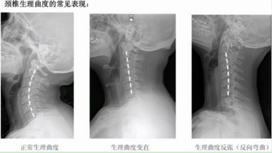 预防颈椎病，选好枕头很关键