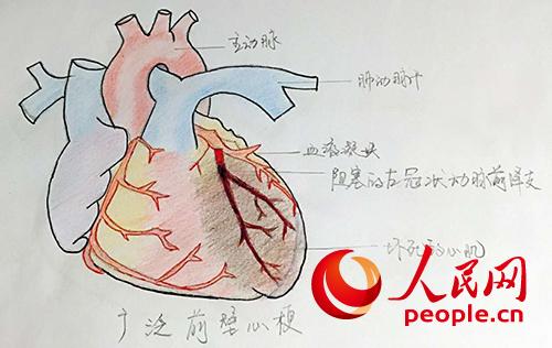 多么“痛”的领悟 心肌梗死急救刻不容缓