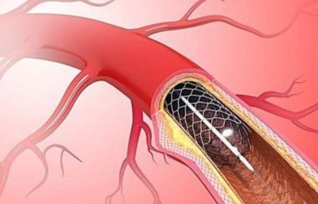 钟南山反对做心脏支架？荒谬谣言不可信！