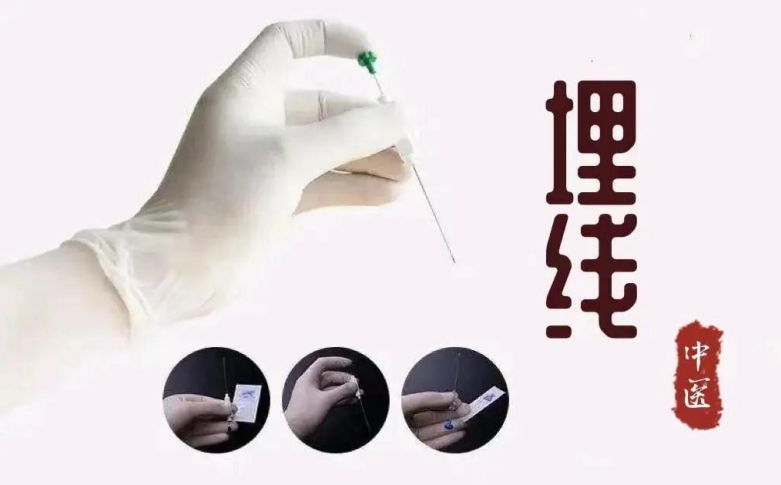 穴位埋线减重——助您轻松享“瘦”