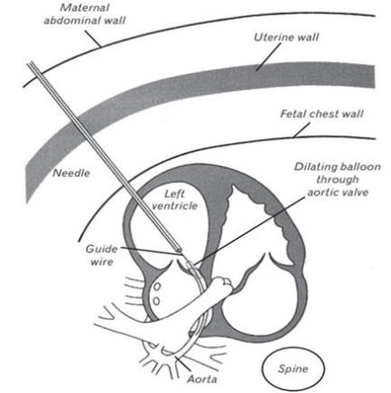 科普慕课｜胎儿心脏也能“修”？聊聊中国先心病介入技术的那些创新突破