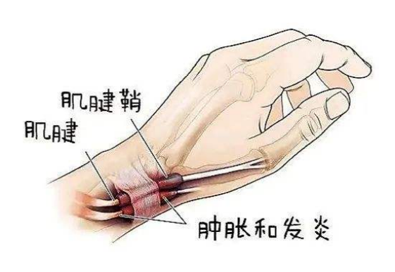 腱鞘炎逐渐年轻化，我们应如何保护好自己的双手？