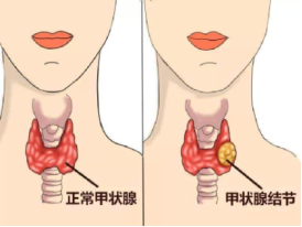 别emo了！警惕甲状腺疾病 | 世界卫生日