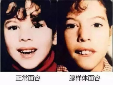 警惕！这种病影响孩子一生的颜值