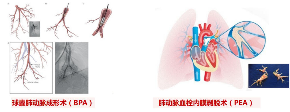 科普慕课｜确诊肺动脉高压后，该如何治疗？