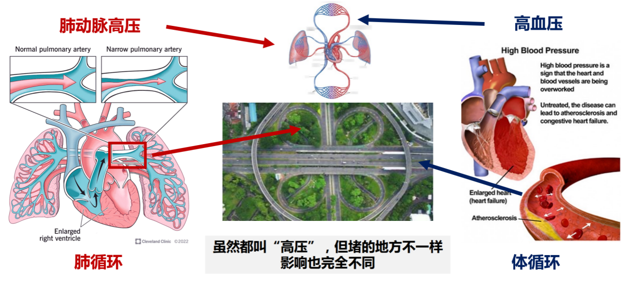 科普慕课｜肺动脉高压和高血压是一回事吗？